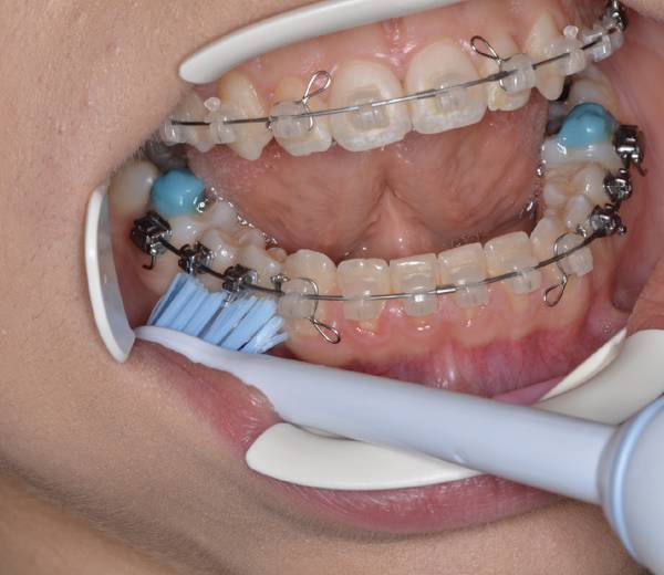 Pevn&aacute; rovn&aacute;tka a č&iacute;&scaron;těn&iacute; Sonicare