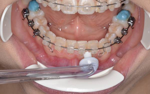 či&scaron;těn&iacute; rovn&aacute;tek airfloss