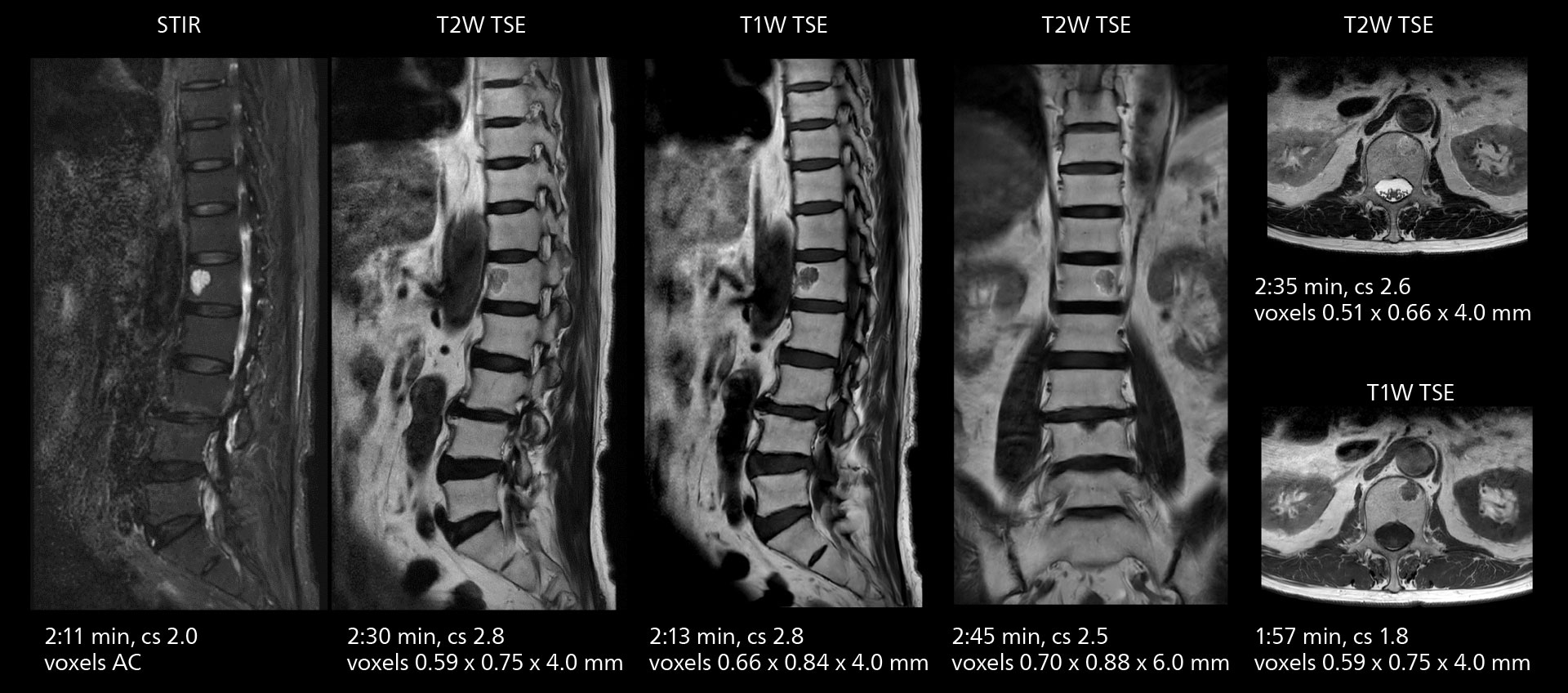 Lumbar spine mri