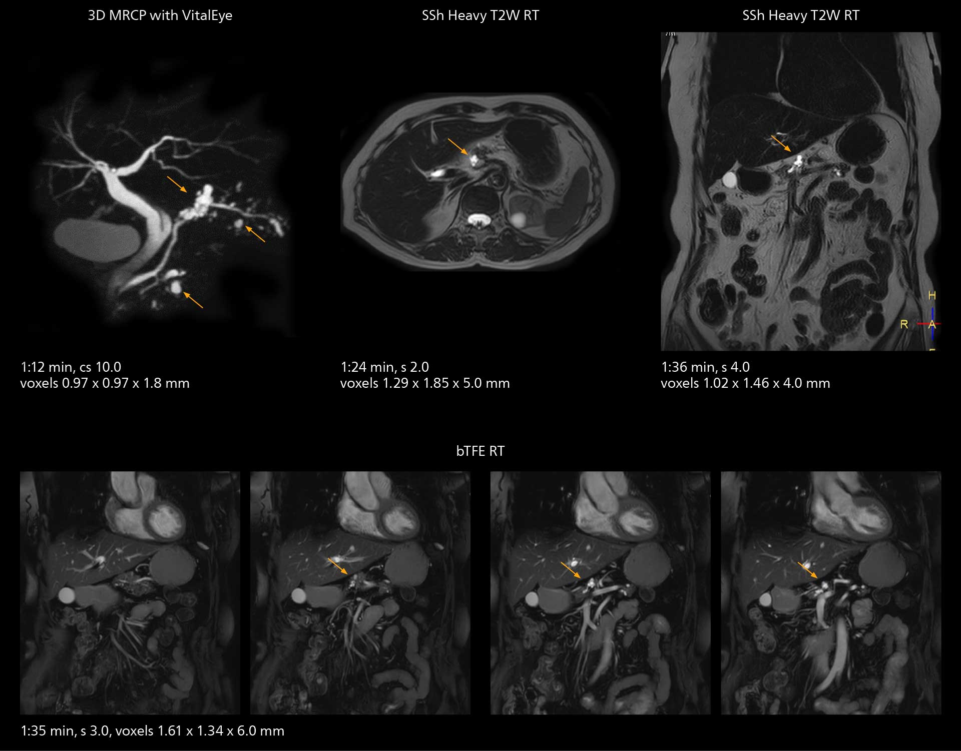 Mrcp mri