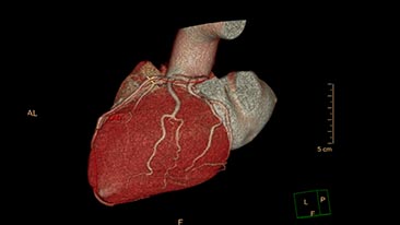 ct spectral comprehensive cardiac analysis