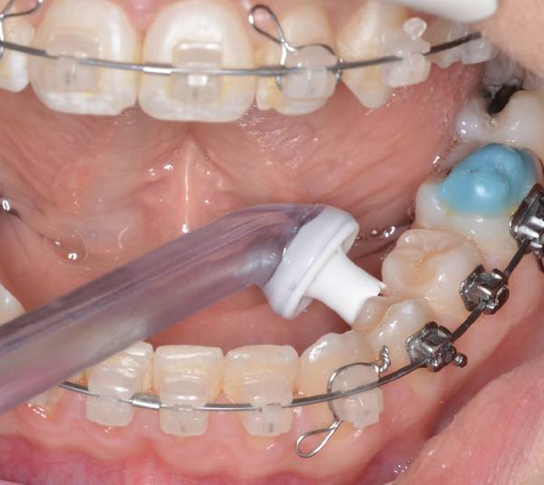 či&scaron;těn&iacute; rovn&aacute;tek airfloss